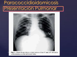 Paracoccidioidomicosis
Presentación Pulmonar

 