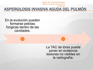 Rippon JW. Tratado de Micología
                         Médica, Hongos y Actinomicetos
                                              patógenos

ASPERGILOSIS INVASIVA AGUDA DEL PULMÓN

En la evolución pueden
   formarse pelotas
fúngicas dentro de las
      cavidades.



                              La TAC de tórax puede
                                poner en evidencia
                              lesiones no visibles en
                                   la radiografía.
 