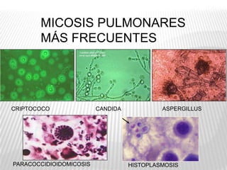 MICOSIS PULMONARES
       MÁS FRECUENTES




CRIPTOCOCO               CANDIDA            ASPERGILLUS




PARACOCCIDIOIDOMICOSIS             HISTOPLASMOSIS
 