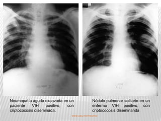 Neumopatía aguda excavada en un              Nódulo pulmonar solitario en un
paciente    VIH     positivo, con            enfermo VIH positivo, con
criptococosis diseminada.                    criptococosis diseminanda
                               www.uaq.mx/rneumo/
 