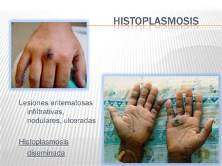 HISTOPLASMOSIS




Lesiones eritematosas
  infiltrativas,
  nodulares, ulceradas

Histoplasmosis
  diseminada
 