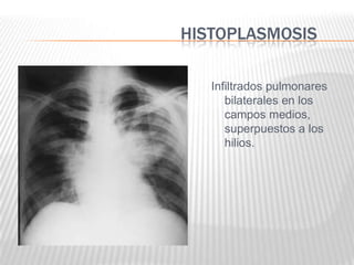 HISTOPLASMOSIS

   Infiltrados pulmonares
      bilaterales en los
      campos medios,
      superpuestos a los
      hilios.
 