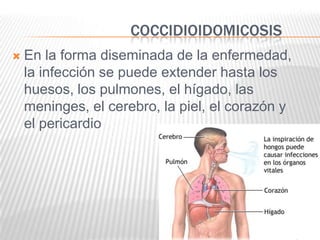 COCCIDIOIDOMICOSIS
   En la forma diseminada de la enfermedad,
    la infección se puede extender hasta los
    huesos, los pulmones, el hígado, las
    meninges, el cerebro, la piel, el corazón y
    el pericardio
 