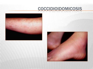 COCCIDIOIDOMICOSIS
 