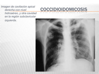 Imagen de cavitación apical
  derecha con nivel            COCCIDIOIDOMICOSIS
  hidroaéreo, y otra cavidad
  en la región subclavicular
  izquierda.
 