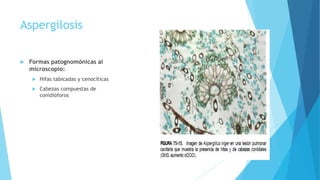 Aspergilosis
 Formas patognomónicas al
microscopio:
 Hifas tabicadas y cenocíticas
 Cabezas compuestas de
conidióforos
 