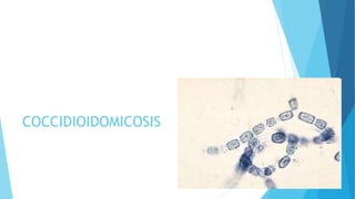 COCCIDIOIDOMICOSIS
 