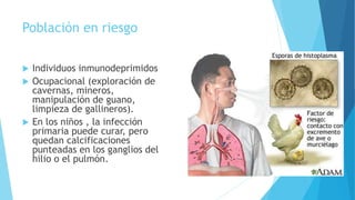 Población en riesgo
 Individuos inmunodeprimidos
 Ocupacional (exploración de
cavernas, mineros,
manipulación de guano,
limpieza de gallineros).
 En los niños , la infección
primaria puede curar, pero
quedan calcificaciones
punteadas en los ganglios del
hilio o el pulmón.
 