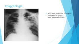 Imagenología
 Infiltrados pulmonares bilaterales
en los campos medios,
superpuestos a los hilios.
 