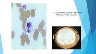  Granulocito de sangre periférica
infectado. Tinción: Giemsa
 