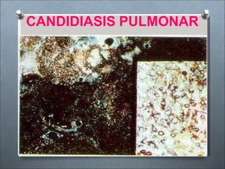CANDIDIASIS PULMONAR
 