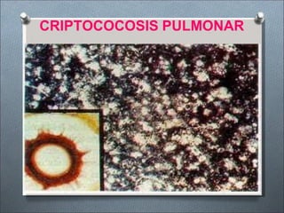 CRIPTOCOCOSIS PULMONAR
 