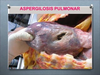 ASPERGILOSIS PULMONAR
 