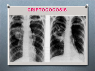 CRIPTOCOCOSIS
 