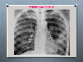 COCCIDIMIOCOSIS
 