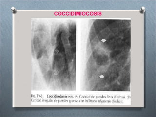 COCCIDIMIOCOSIS
 