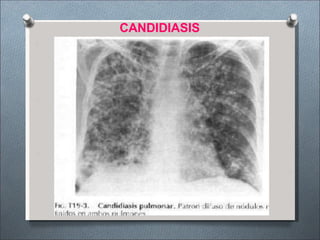CANDIDIASIS
 