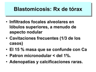 Blastomicosis: Rx de tórax
• Infiltrados focales alveolares en
lóbulos superiores, a menudo de
aspecto nodular
• Cavitaciones frecuentes (1/3 de los
casos)
• El 15 % masa que se confunde con Ca
• Patron micronodular < del 1%.
• Adenopatías y calcificaciones raras.
 