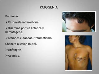 PATOGENIA
Pulmonar.
Respuesta inflamatoria.
Disemina por vía linfática y
hematógena.
Lesiones cutáneas…traumatismo.
Chancro o lesión Inicial.
Linfangitis.
Adenitis.

 