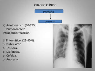 CUADRO CLÍNICO.
Primaria
pulmonar

a) Asintomático: (60-75%)
Primocontacto.
Intradermorreacción.
b)Sintomático: (25-40%).
o Fiebre 40°C
o Tos seca.
o Diaforesis.
o Cefalea.
o Anorexia.

 