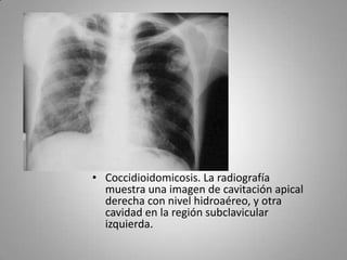 • Coccidioidomicosis. La radiografía
muestra una imagen de cavitación apical
derecha con nivel hidroaéreo, y otra
cavidad en la región subclavicular
izquierda.

 