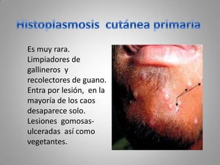 Es muy rara.
Limpiadores de
gallineros y
recolectores de guano.
Entra por lesión, en la
mayoría de los caos
desaparece solo.
Lesiones gomosasulceradas así como
vegetantes.

 