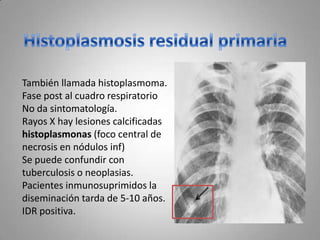 También llamada histoplasmoma.
Fase post al cuadro respiratorio
No da sintomatología.
Rayos X hay lesiones calcificadas
histoplasmonas (foco central de
necrosis en nódulos inf)
Se puede confundir con
tuberculosis o neoplasias.
Pacientes inmunosuprimidos la
diseminación tarda de 5-10 años.
IDR positiva.

 