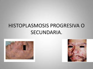 HISTOPLASMOSIS PROGRESIVA O
SECUNDARIA.

 