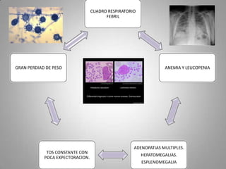CUADRO RESPIRATORIO
FEBRIL

GRAN PERDIAD DE PESO

TOS CONSTANTE CON
POCA EXPECTORACION.

ANEMIA Y LEUCOPENIA

ADENOPATIAS MULTIPLES.
HEPATOMEGALIAS.
ESPLENOMEGALIA

 