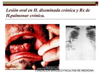 FUNDACION BARCELO FACULTAD DE MEDICINA
Lesión oral en H. diseminada crónica y Rx de
H.pulmonar crónica.
 