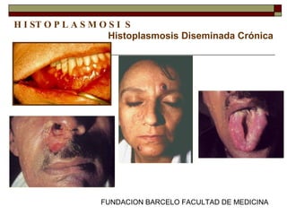 FUNDACION BARCELO FACULTAD DE MEDICINA
Histoplasmosis Diseminada Crónica
H I ST O P L A S M O S I S
Diagnóstico diferencial con
leishmaniasis
 