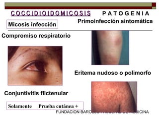 FUNDACION BARCELO FACULTAD DE MEDICINA
Primoinfección sintomática
C O C C I D I O I D O M I C O S I SC O C C I D I O I D O M I C O S I S P A T O G E N I A
Micosis infección
Compromiso respiratorio
Eritema nudoso o polimorfo
Conjuntivitis flictenular
Solamente Prueba cutánea +
 