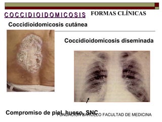 FUNDACION BARCELO FACULTAD DE MEDICINACompromiso de piel, hueso, SNC
FORMAS CLÍNICAS
Coccidioidomicosis cutánea
Coccidioidomicosis diseminada
C O C C I D I O I D O M I C O S I SC O C C I D I O I D O M I C O S I S
 