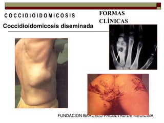 FUNDACION BARCELO FACULTAD DE MEDICINA
C O C C I D I O I D O M I C O S I S FORMAS
CLÍNICAS
Coccidioidomicosis diseminada
 