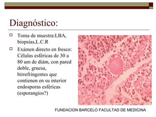 FUNDACION BARCELO FACULTAD DE MEDICINA
Diagnóstico:
 Toma de muestra:LBA,
biopsias,L.C.R
 Exámen directo en fresco:
Células esféricas de 30 a
80 um de diám, con pared
doble, gruesa,
birrefringentes que
contienen en su interior
endosporas esféricas
(esporangios?)
 