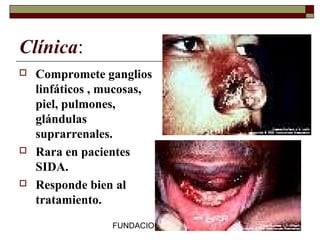 FUNDACION BARCELO FACULTAD DE MEDICINA
Clínica:
 Compromete ganglios
linfáticos , mucosas,
piel, pulmones,
glándulas
suprarrenales.
 Rara en pacientes
SIDA.
 Responde bien al
tratamiento.
 