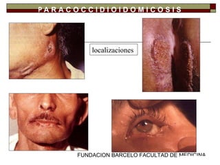 FUNDACION BARCELO FACULTAD DE MEDICINA
P A R A C O C C I D I O I D O M I C O S I S
localizaciones
 