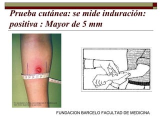 FUNDACION BARCELO FACULTAD DE MEDICINA
Prueba cutánea: se mide induración:
positiva : Mayor de 5 mm
 