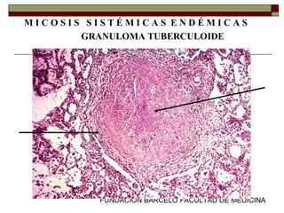 FUNDACION BARCELO FACULTAD DE MEDICINA
M I C O S I S S I S T É M I C A S E N D É M I C A S
GRANULOMA TUBERCULOIDE
 