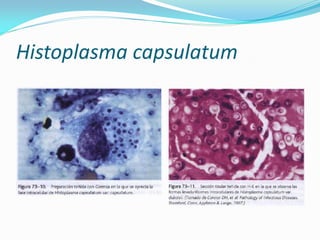 Histoplasma capsulatum  