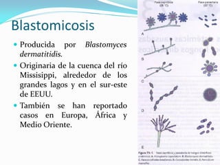 Blastomicosis 
Producida por Blastomyces dermatitidis. 
Originaria de la cuenca del río Missisippi, alrededor de los grandes lagos y en el sur-este de EEUU. 
También se han reportado casos en Europa, África y Medio Oriente.  