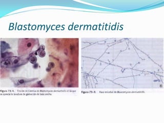 Blastomyces dermatitidis  