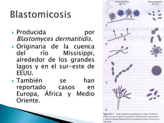  Producida por
Blastomyces dermatitidis.
 Originaria de la cuenca
del río Missisippi,
alrededor de los grandes
lagos y en el sur-este de
EEUU.
 También se han
reportado casos en
Europa, África y Medio
Oriente.
 