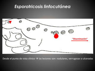 Esporotricosis linfocutánea
“Diseminación”
Desde el punto de vista clínico  las lesiones son: nodulares, verrugosas o ulceradas
 
