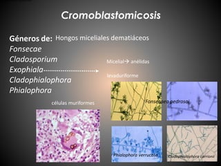 Cromoblastomicosis
Géneros de:
Fonsecae
Cladosporium
Exophiala
Cladophialophora
Phialophora
Hongos miceliales dematiáceos
Micelial anélidas
levaduriforme
células muriformes
Fonsecaea pedrosoi
Fonsecaea pedrosoi
Phialophora verrucosa Cladophialophora carrionii
 