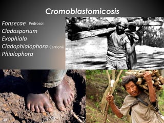 Cromoblastomicosis
Fonsecae
Cladosporium
Exophiala
Cladophialophora
Phialophora
Pedrosoi
Carrionii
 