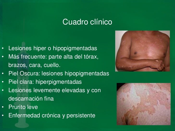Micosis superficiales