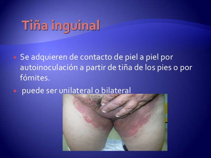 Como discernir el hongo de la piel de los pies