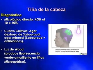Diagnóstico
• Micológico directo: KOH al
10 o 40%.
• Cultivo Cultivos: Agar
dextrosa de Sabouraud,
agar micosel (Sabouraud +
antibióticos).
• Luz de Wood
(produce fluorescencia
verde-amarillento en tiñas
Microspórica).
Tiña de la cabeza
 