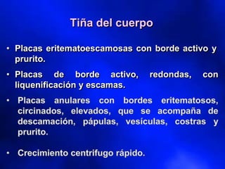 Tiña del cuerpo
• Placas eritematoescamosas con borde activo y
prurito.
• Placas de borde activo, redondas, con
liquenificación y escamas.
 